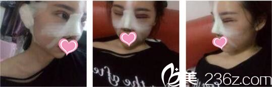 韩国UNIMEDI整形外科尹仁模韩式双眼皮+假体隆鼻真人案例术后第二天 韩国UNIMEDI整形外科尹仁模韩式双眼皮+假体隆鼻真人案例术后第二天