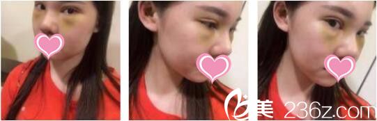 韩国UNIMEDI整形外科尹仁模韩式双眼皮+假体隆鼻真人案例术后第七天 韩国UNIMEDI整形外科尹仁模韩式双眼皮+假体隆鼻真人案例术后第七天