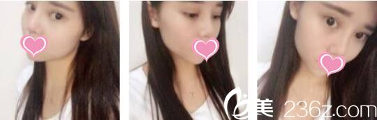 韩国UNIMEDI整形外科尹仁模韩式双眼皮+假体隆鼻真人案例术后一个月 韩国UNIMEDI整形外科尹仁模韩式双眼皮+假体隆鼻真人案例术后一个月