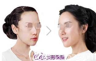 全胤株院长MISKO隆鼻整形案例 全胤株院长MISKO隆鼻整形案例