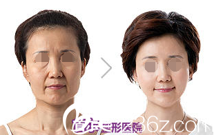 脸部脂肪移植术案例 脸部脂肪移植术案例
