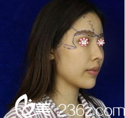 我的术前照片 我的术前照片