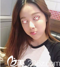 何山自体脂肪填充太阳穴术后一周 何山自体脂肪填充太阳穴术后一周