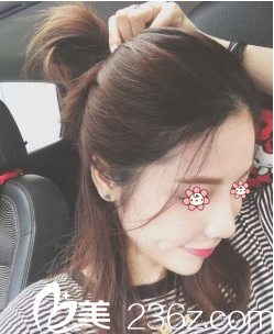 乌鲁木齐伊丽莎白整形自体脂肪面部填充术后半个月 乌鲁木齐伊丽莎白整形自体脂肪面部填充术后半个月