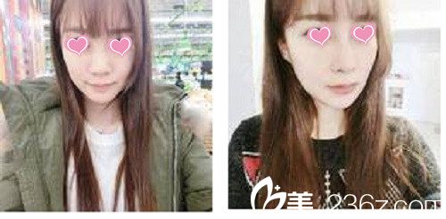 韩国星期八整形外科·皮肤科隆鼻手术案例