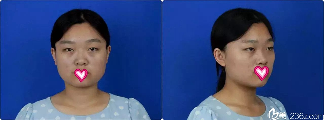 术前样子普通想做双眼皮和改脸型 术前样子普通想做双眼皮和改脸型