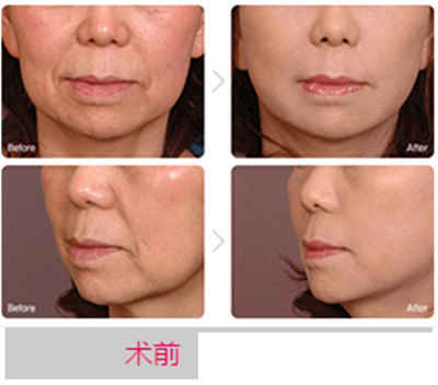 鲁峰<!--<i data=20240703-sp></i>-->长面部除皱手术案例 鲁峰<!--<i data=20240703-sp></i>-->长面部除皱手术案例