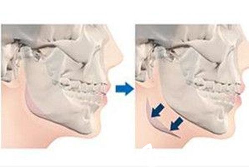 下颌角手术 下颌角手术