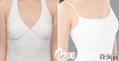 韩国id整形做假体隆胸术前照 韩国id整形做假体隆胸术前照