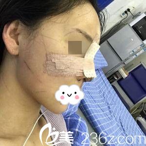 术后当天的我 术后当天的我