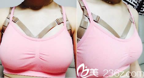 韩国id整形医院假体隆胸一个月照片