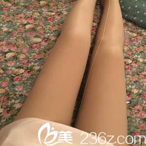 吸脂瘦腿术后第九天效果