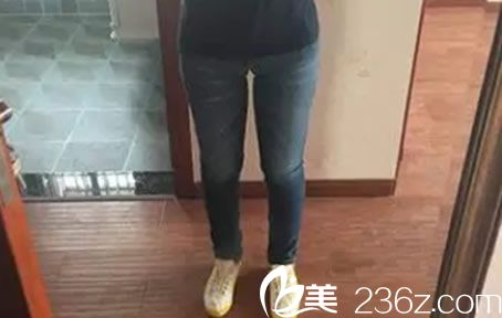 吸脂后15天后恢复效果 吸脂后15天后恢复效果