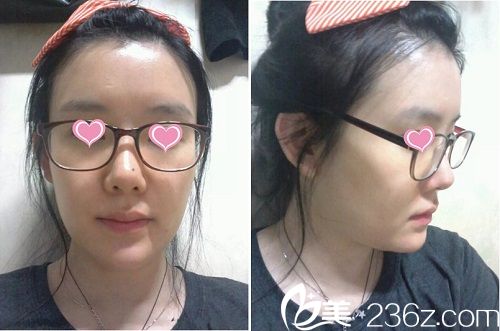 面部轮廓手术前照片 面部轮廓手术前照片