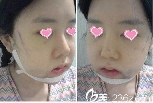 下颌角手术后3天 下颌角手术后3天