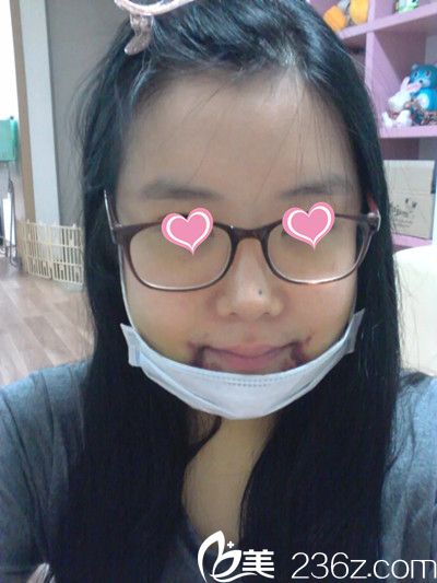 颧骨手术后10天 颧骨手术后10天