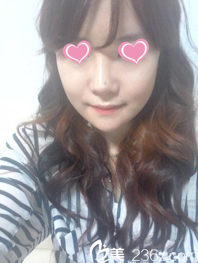 韩国星期八整形医院面部轮廓手术案例 韩国星期八整形医院面部轮廓手术案例