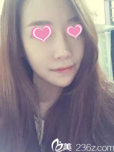 韩哪家医院做面部轮廓手术好？分享下妹子在韩国星期八整形做颧骨颧弓整形+下颌角手术过程