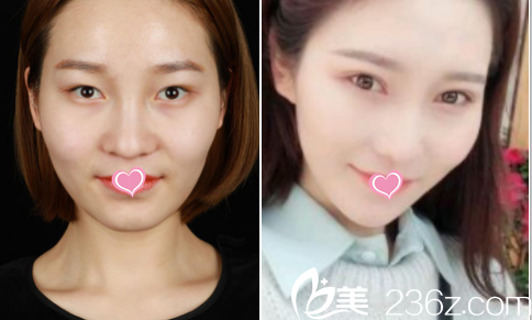 北京叶子眼综合案例 北京叶子眼综合案例