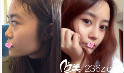 北京叶子鼻修复案例 北京叶子鼻修复案例