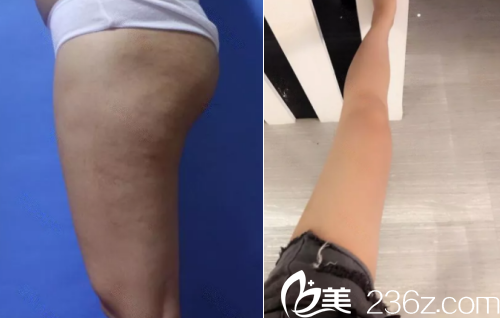 北京叶子腿部吸脂案例 北京叶子腿部吸脂案例