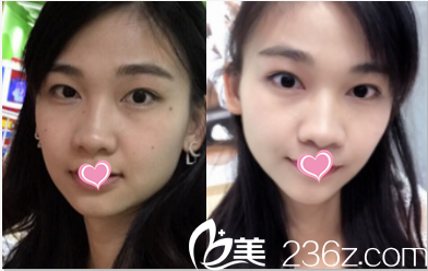 北京叶子激光点痣案例 北京叶子激光点痣案例