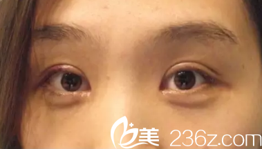 术后7天眼睛微肿 术后7天眼睛微肿