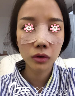 我去重庆美仑美奂医院做完手术当天 我去重庆美仑美奂医院做完手术当天