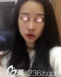 姬广翰硅胶假体隆鼻术后一周 姬广翰硅胶假体隆鼻术后一周