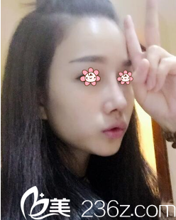 重庆美仑美奂硅胶隆鼻术后半个月 重庆美仑美奂硅胶隆鼻术后半个月