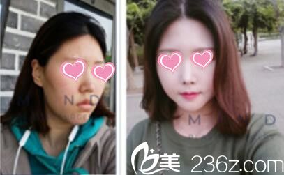 mind整形外科真人鼻综合术前术后效果对比 mind整形外科真人鼻综合术前术后效果对比
