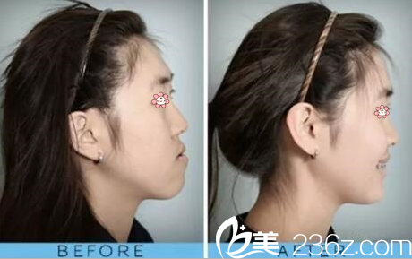 <!--<i data=20240703-sp></i>-->院长矫正突嘴案例