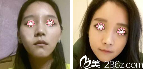 金寿信院长颧骨缩小手术案例 金寿信院长颧骨缩小手术案例