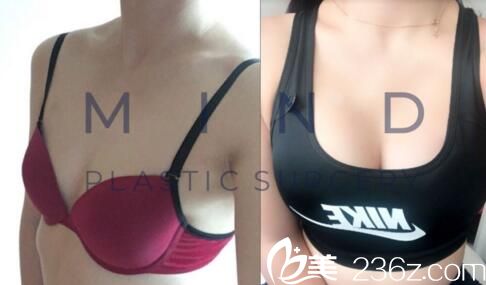 mind整形外科李永泽胸部整形真人前后对比
