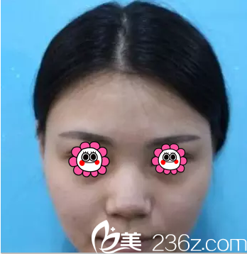 在北京叶子做假体鼻综合前样子 在北京叶子做假体鼻综合前样子