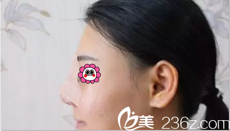 找洪春做假体鼻综合隆鼻第3天样子 找洪春做假体鼻综合隆鼻第3天样子