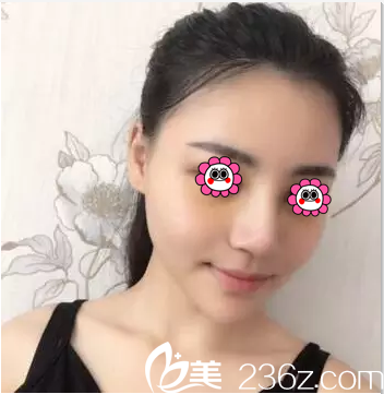 北京叶子假体鼻综合隆鼻案例第10天效果 北京叶子假体鼻综合隆鼻案例第10天效果