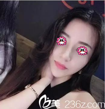 洪春鼻综合隆鼻案例 洪春鼻综合隆鼻案例