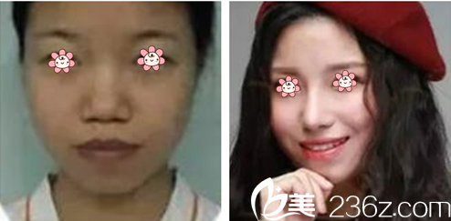 高应烈院长隆鼻案例 高应烈院长隆鼻案例