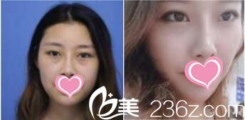 韩国VIZ整形外科医院金钟灿激光去眼袋真人案例 韩国VIZ整形外科医院金钟灿激光去眼袋真人案例