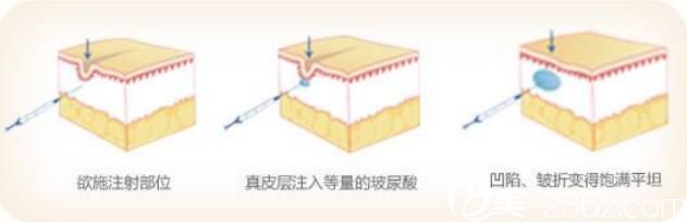 韩国VIZ整形外科医院金锡柱玻尿酸除皱 韩国VIZ整形外科医院金锡柱玻尿酸除皱