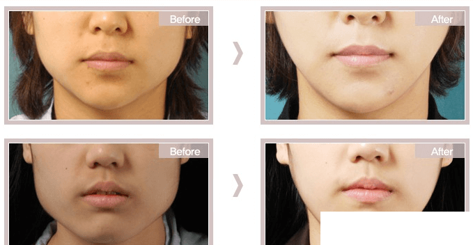 韩国美多丽娜MEDITRINA整形医院下颌角手术案例 韩国美多丽娜MEDITRINA整形医院下颌角手术案例