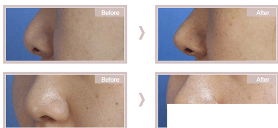 韩国美多丽娜MEDITRINA整形医院鼻部整形案例 韩国美多丽娜MEDITRINA整形医院鼻部整形案例