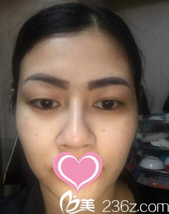 在韩国MIND医院做双眼皮术前照 在韩国MIND医院做双眼皮术前照