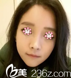 金寿信颧骨缩小加下颌角术后一个月 金寿信颧骨缩小加下颌角术后一个月