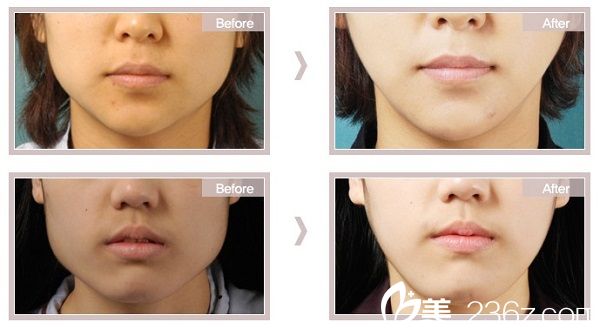 李成国院长下颌角手术案例 李成国院长下颌角手术案例