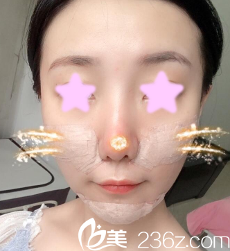 我在大同清木做面部自体脂肪填充后第3天照片