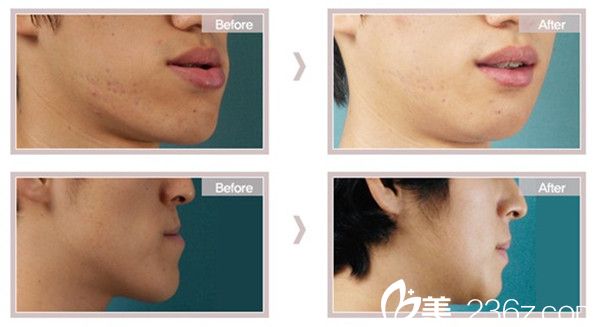 尹侯俊院长撅下巴（地包天）整形手术案例