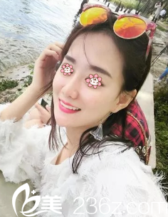 彭利涛假体隆鼻失败修复术后半个月 彭利涛假体隆鼻失败修复术后半个月