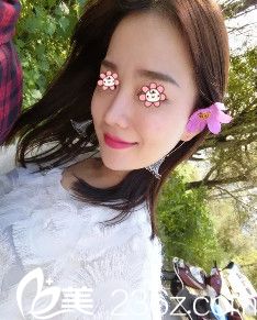 重庆时光整形假体隆鼻失败修复术后40天 重庆时光整形假体隆鼻失败修复术后40天